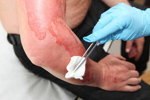 HCCs Help Utah Prepare for Burn Mass Casualty Incidents